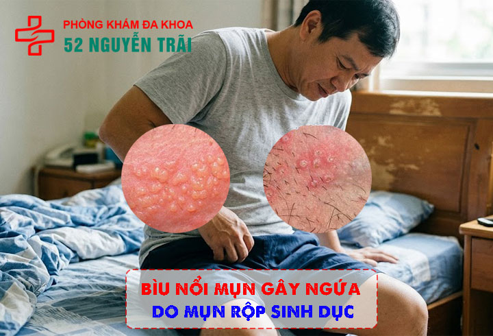 Bìu nổi mụn gây ngứa do Mụn rộp sinh dục