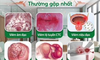 Ngứa vùng kín: Dấu hiệu, nguyên nhân và cách điều trị