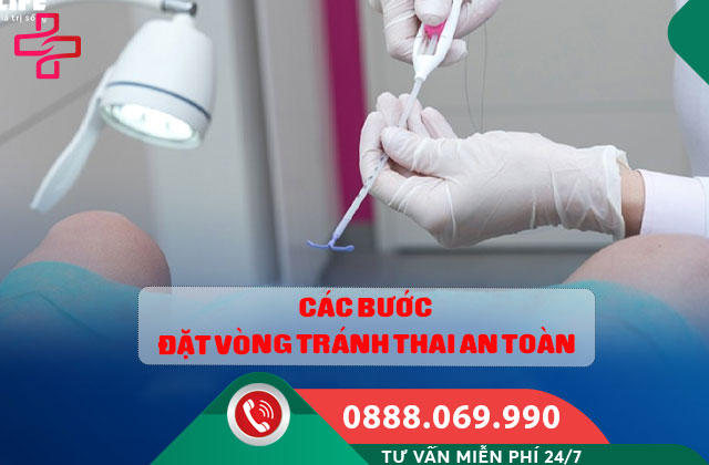 Các bước đặt vòng tránh thai an toàn