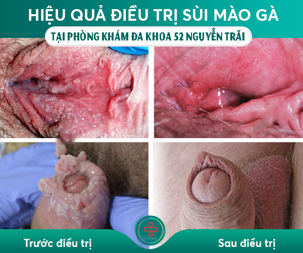 cách chữa sùi mào gà