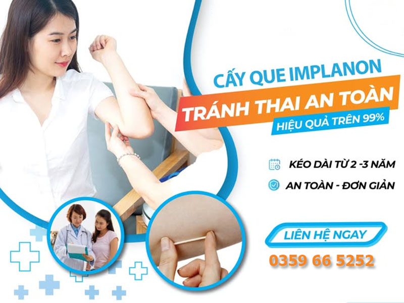 Cấy Que Tránh Thai