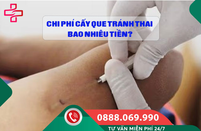 Chi phí cấy que tránh thai bao nhiêu tiền?