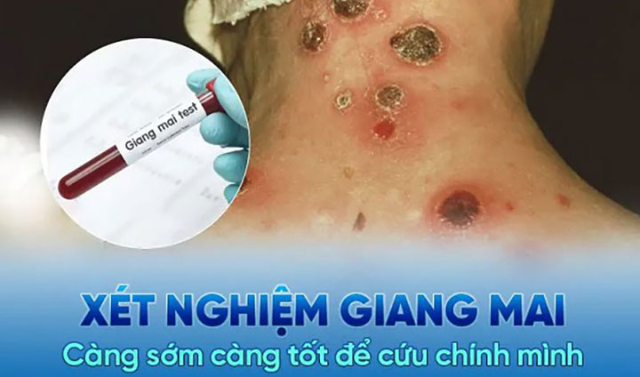 Chi phí chữa bệnh giang mai