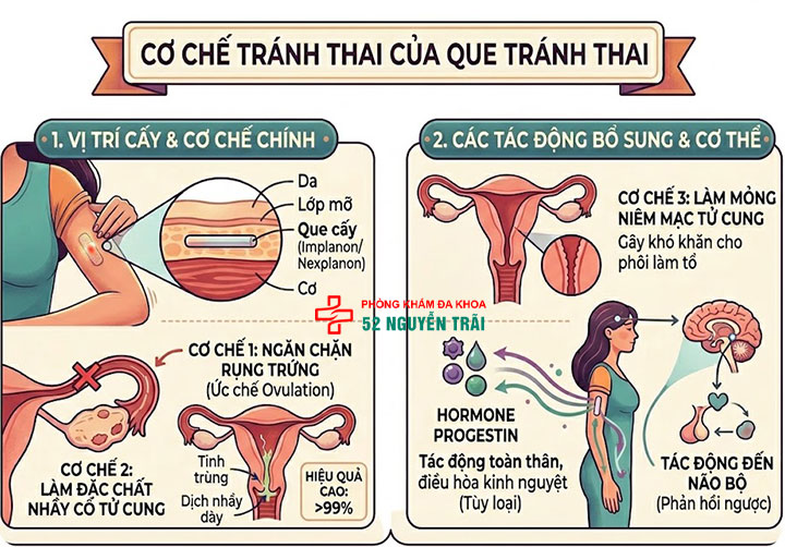 Cấy que tránh thai: Giải pháp ngừa thai hiện đại, an toàn 2 Cơ chế tránh thai của que tránh thai