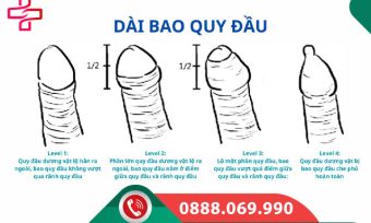 Như thế nào là dài bao quy đầu?