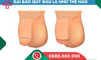 Chi phí phẫu thuật dài bao quy đầu bao nhiêu? Cập nhật 2026