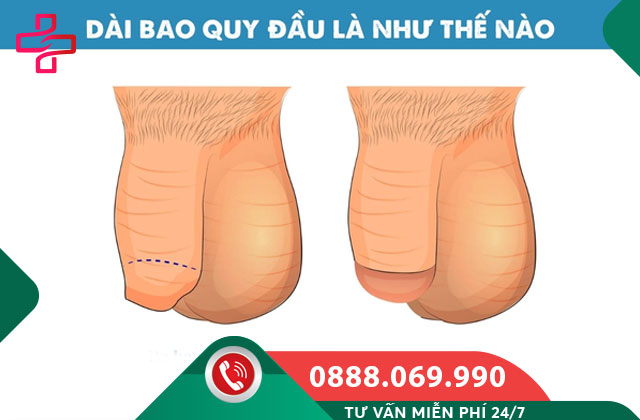 Dài bao quy đầu là gì?