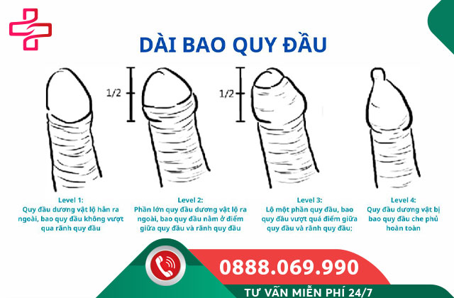 Như thế nào là dài bao quy đầu?