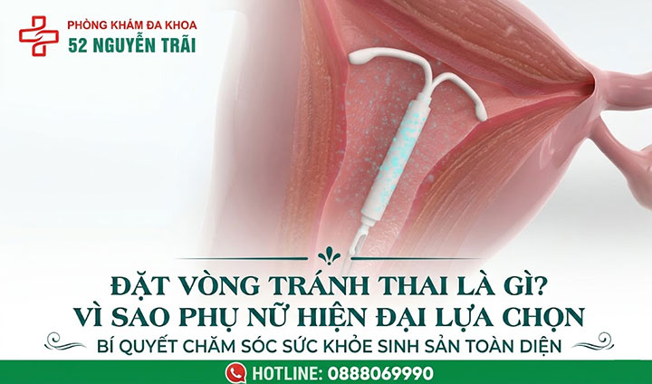 Đặt vòng tránh thai: Phương pháp ngừa thai an toàn, hiệu quả 1 Đặt vòng tránh thai là gì?