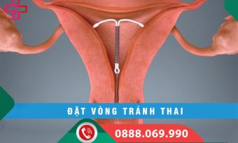 Đặt vòng tránh thai là gì?
