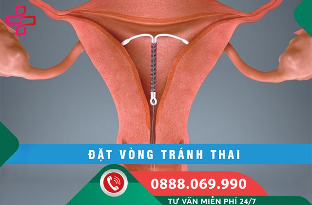Đặt vòng tránh thai là gì?