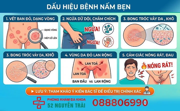 Nấm bẹn do đâu? Cách phòng ngừa và điều trị dứt điểm 3 Dấu hiệu bệnh nấm bẹn