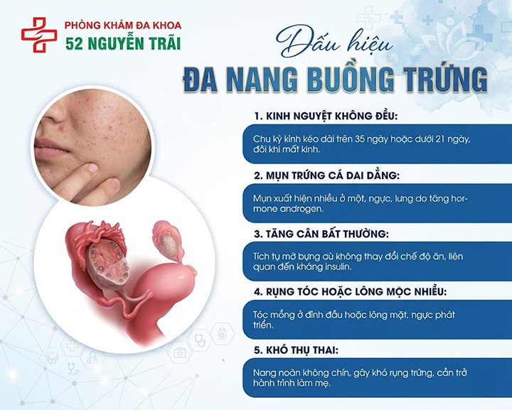 Chậm kinh là gì? Nguyên nhân thường gặp và cách chữa 8 dấu hiệu đa nang buồng trứng