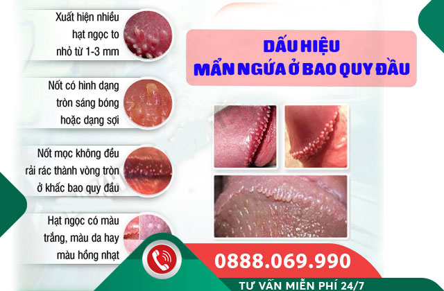 Dấu hiệu Mẩn ngứa ở bao quy đầu