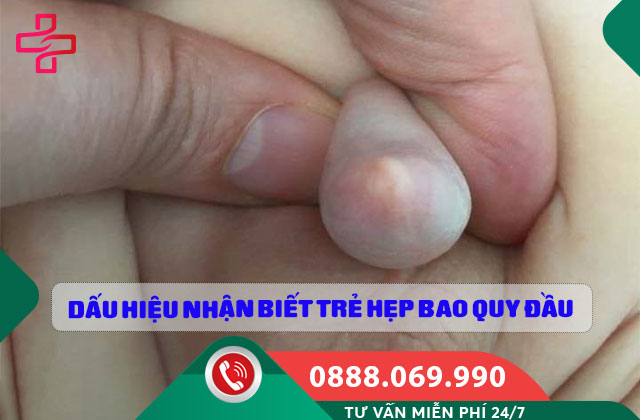 Dấu hiệu nhận biết trẻ hẹp bao quy đầu