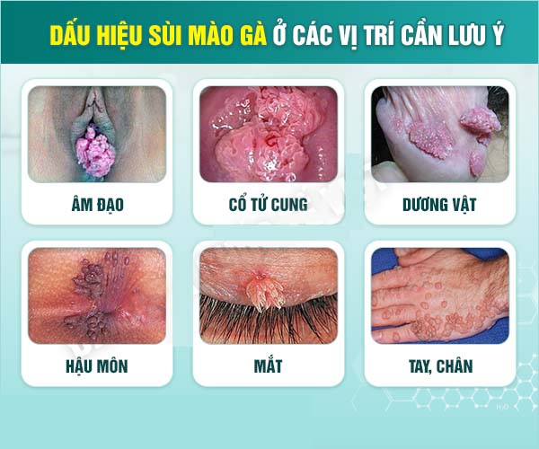 Dấu hiệu sùi mào gà giai đoạn đầu