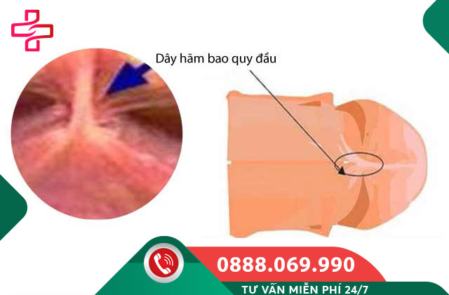 Dây hãm bao quy đầu