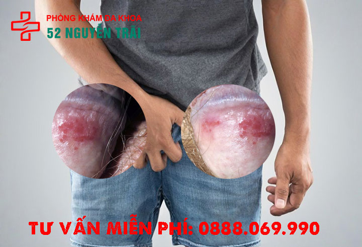 Dương vật bị sưng do phản ứng dị ứng