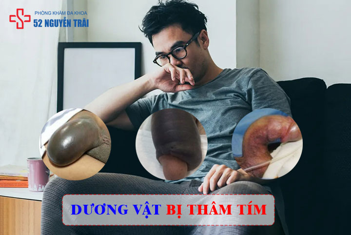 Dương vật bị thâm tím là dấu hiệu gì? Nguyên nhân và cách chữa