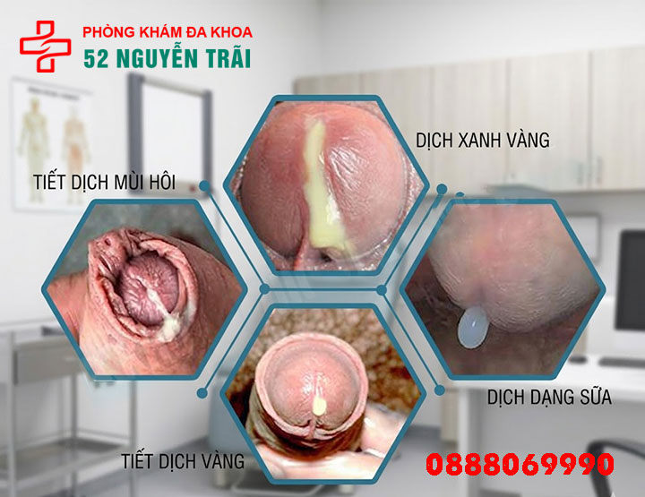 Dương Vật Chảy Mủ: Đừng Chủ Quan Với Triệu Chứng Này