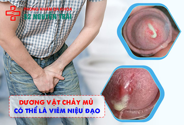 Dương Vật Chảy Mủ Có Thể Là Viêm Niệu Đạo