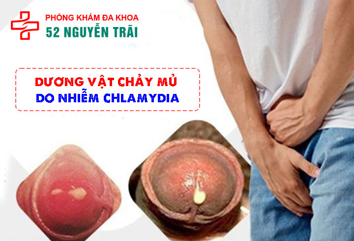 Dương Vật Chảy Mủ Do Nhiễm Chlamydia