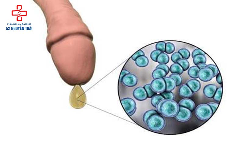 Dương vật chảy mủ