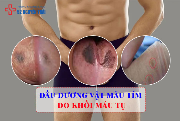 dương vật màu tím do khối máu tụ
