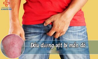 Dương vật nổi mẩn đỏ