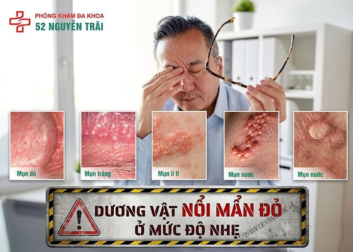 dương vật nổi mẩn đỏ ở Mức độ nhẹ