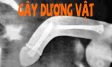 Gãy dương vật