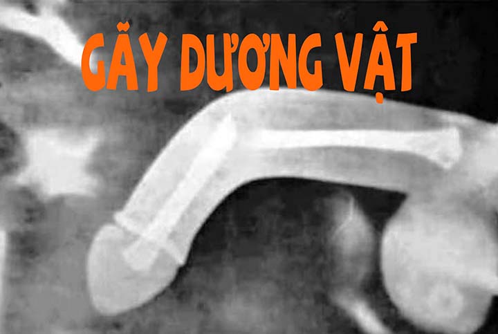 Gãy dương vật