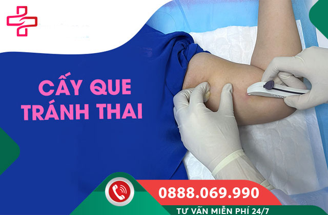 Hiệu quả tránh thai của que cấy