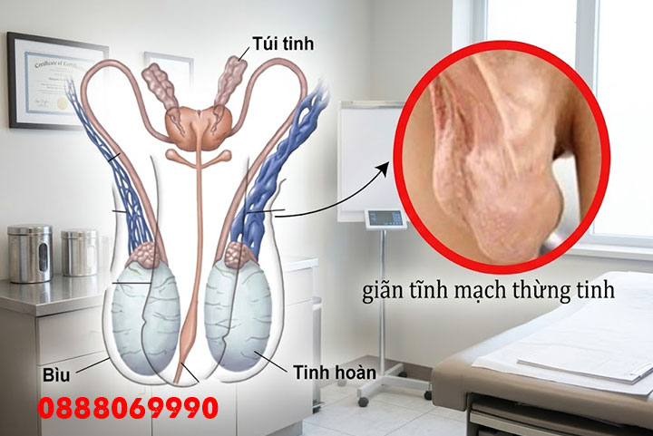 Giãn tĩnh mạch thừng tinh: Dấu hiệu nhận biết và nguy cơ vô sinh nam