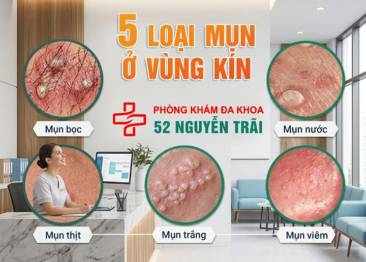 Mụn thịt ở vùng kín nam là gì? Nguyên nhân và cách điều trị