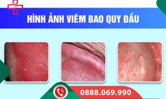 Tìm hiểu về bệnh viêm bao quy đầu