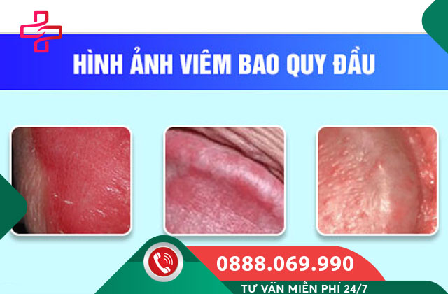 Tìm hiểu về bệnh viêm bao quy đầu