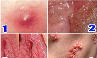 Vùng kín nổi mụn do đâu? Cách điều trị an toàn, hiệu quả