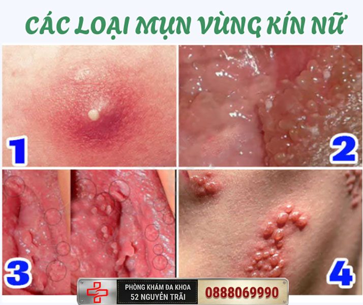 Hình ảnh vùng kín nổi mụn