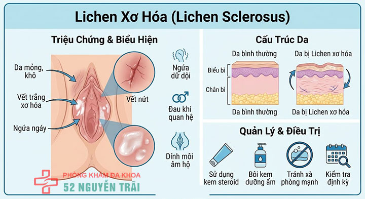 Vùng kín nổi hạch do đâu? Cách điều trị an toàn, hiệu quả 6 Lichen xơ hóa