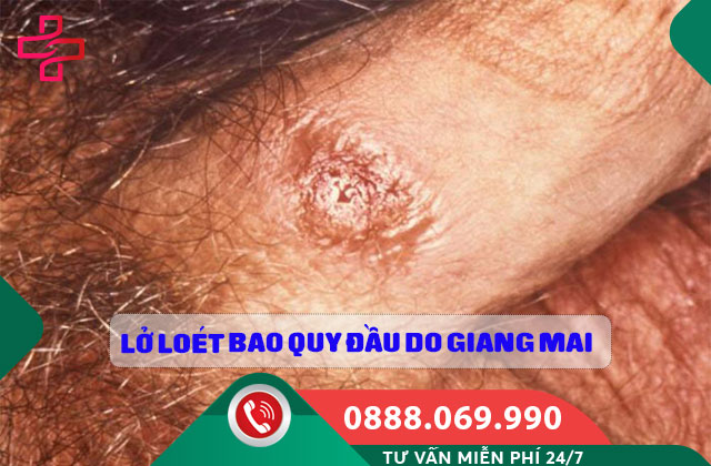 Lở loét bao quy đầu do Giang mai