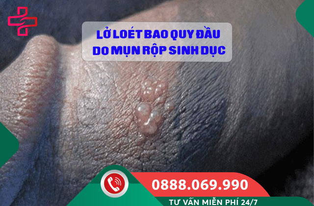 Lở loét bao quy đầu do Mụn rộp sinh dục