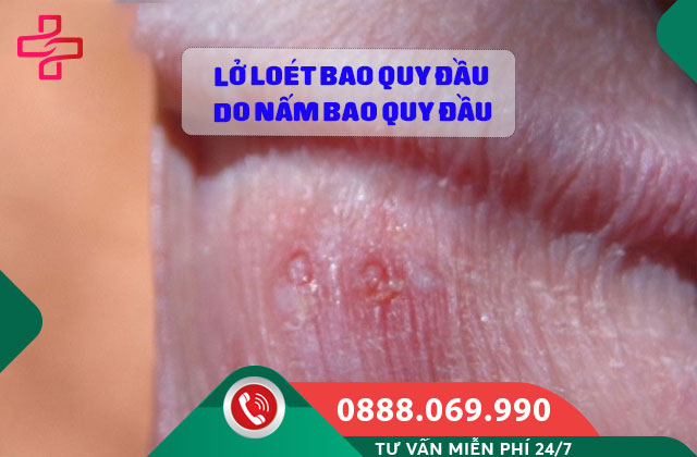 Lở loét bao quy đầu do Nấm bao quy đầu