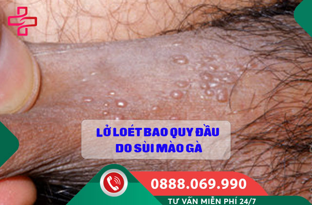 Lở loét bao quy đầu do Sùi mào gà