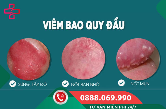Lở loét bao quy đầu do Viêm bao quy đầu
