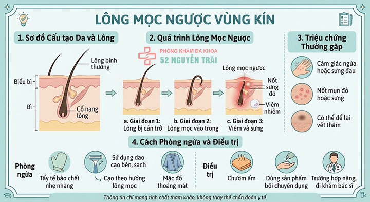 Vùng kín nổi hạch do đâu? Cách điều trị an toàn, hiệu quả 4 Lông mọc ngược vùng kín