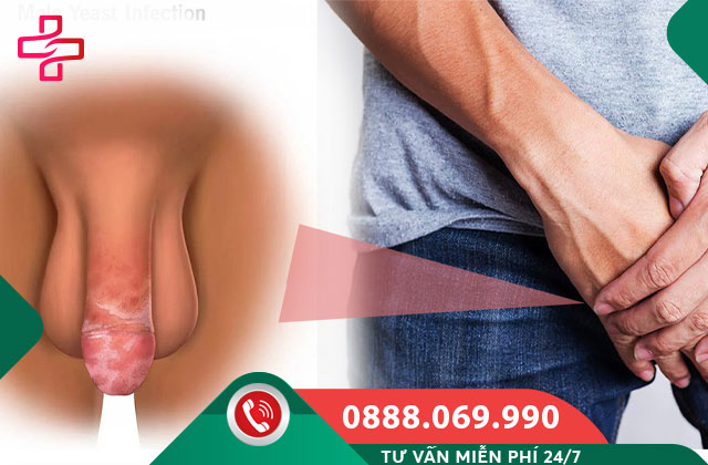 Mẩn ngứa ở bao quy đầu