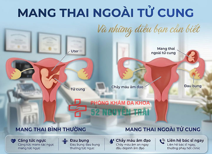 Đau bụng dưới ở phụ nữ 9 Mang thai ngoài tử cung