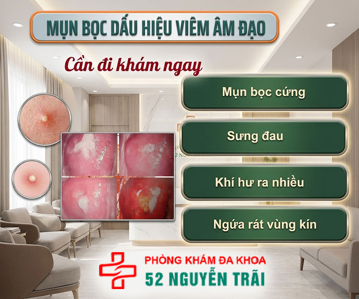 Mụn bọc ở vùng kín – Dấu hiệu cảnh báo viêm âm đạo