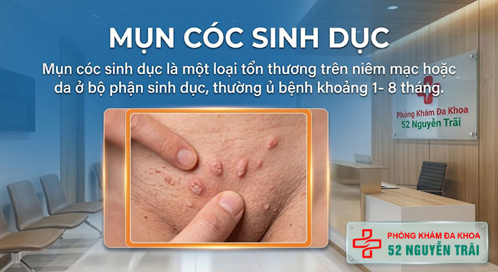 Mụn thịt ở vùng kín 5 Mụn cóc sinh dục